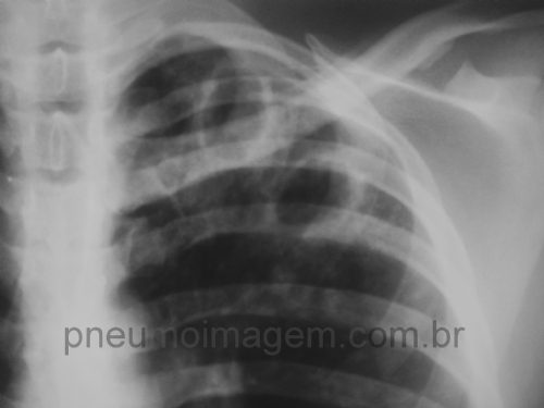 DIAGN�STICO E TRATAMENTO DA TUBERCULOSE RESISTENTE A F�RMACOS: FA�A O DOWNLOAD